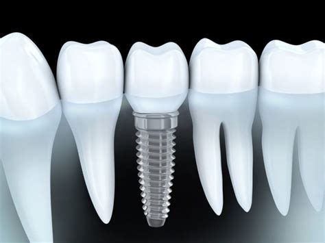 most affordable dental implants near me